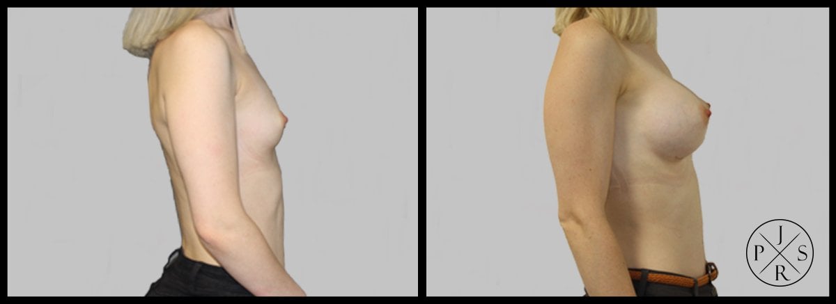 Breast Augmentation Before & After Image