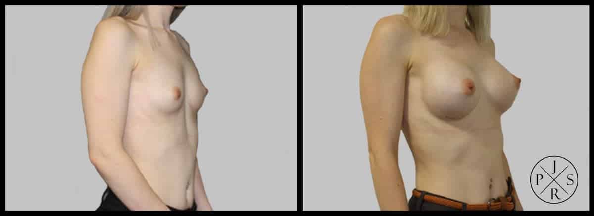 Breast Augmentation Before & After Image