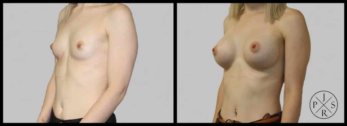 Breast Augmentation Before & After Image