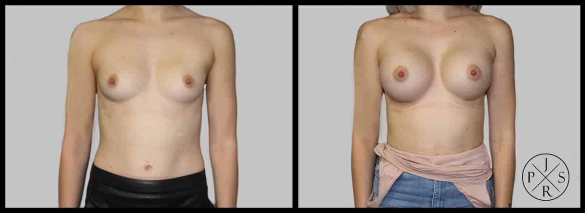 Breast Augmentation Before & After Image