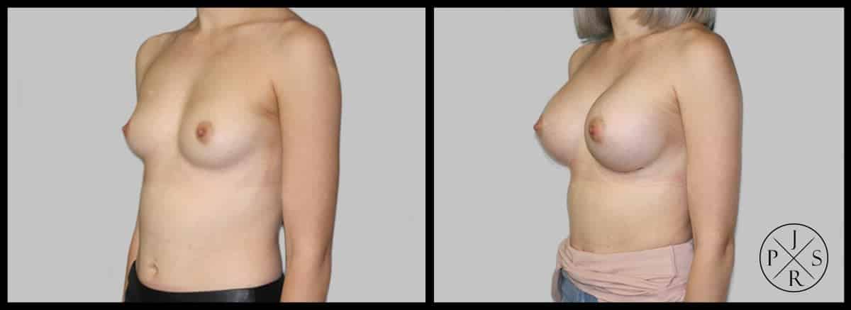 Breast Augmentation Before & After Image