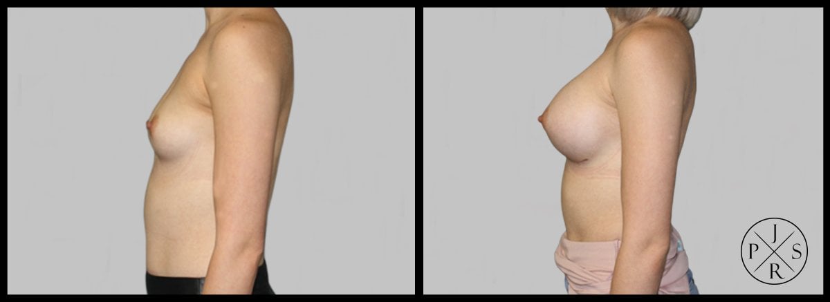 Breast Augmentation Before & After Image