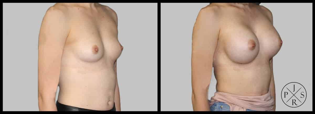 Breast Augmentation Before & After Image