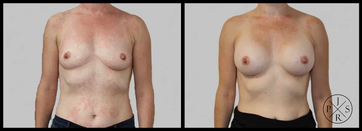 Breast Augmentation Before & After Image