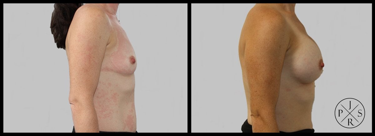 Breast Augmentation Before & After Image