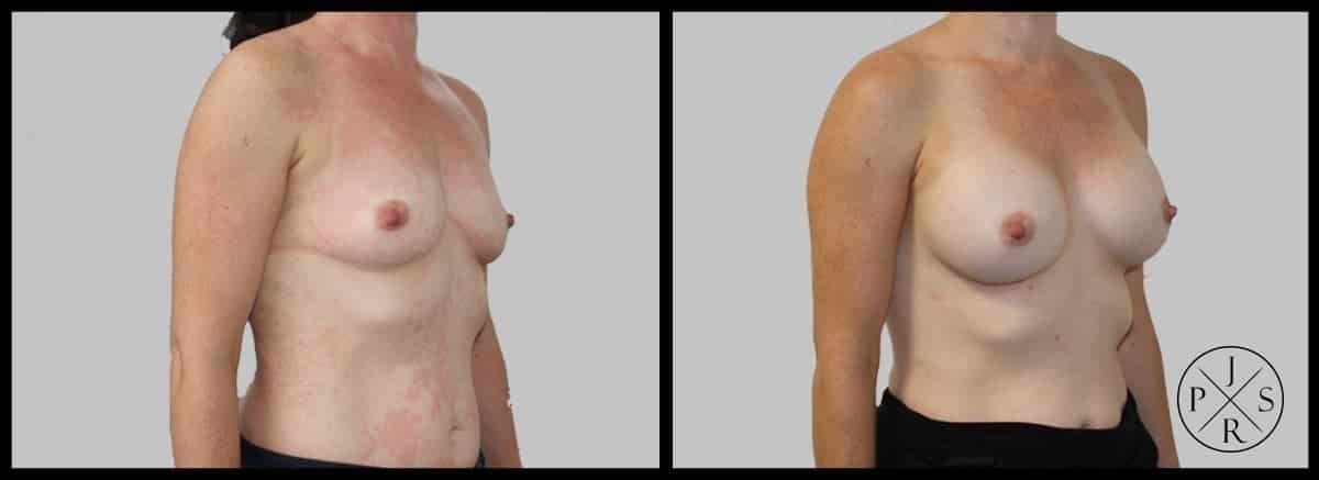 Breast Augmentation Before & After Image