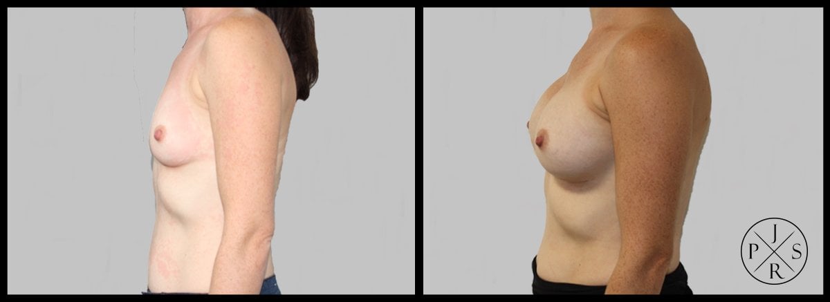 Breast Augmentation Before & After Image