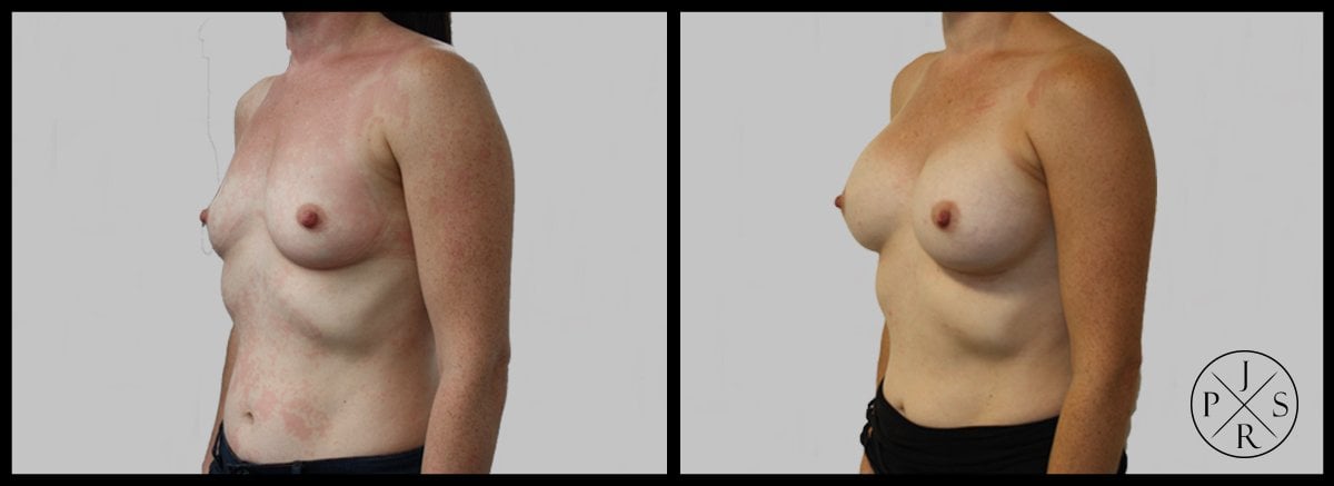 Breast Augmentation Before & After Image