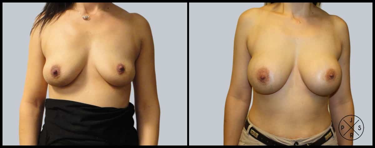 Breast Augmentation Before & After Image