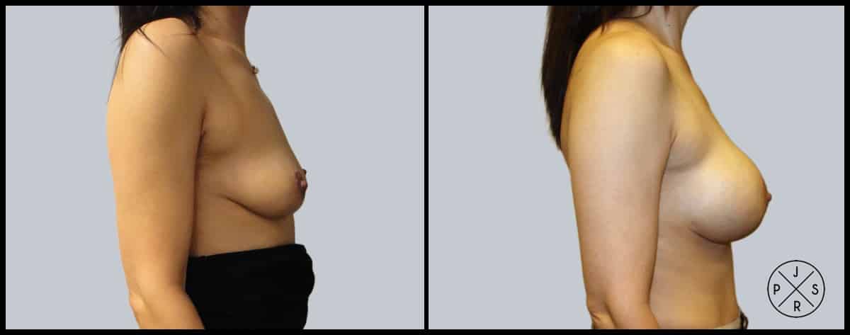 Breast Augmentation Before & After Image