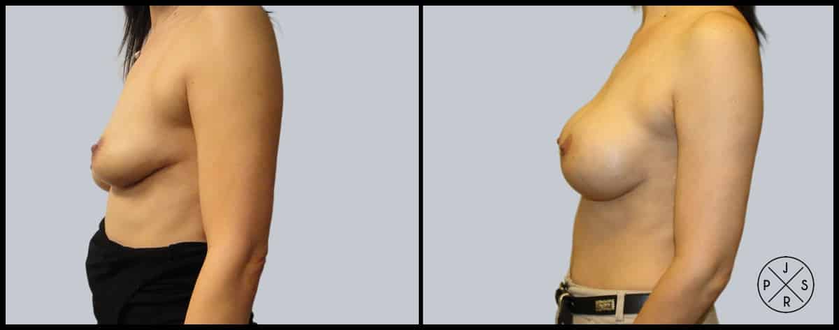 Breast Augmentation Before & After Image