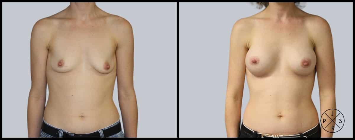 Breast Augmentation Before & After Image