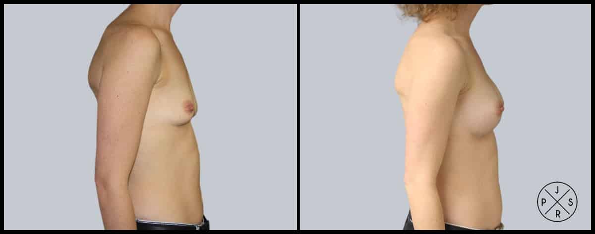 Breast Augmentation Before & After Image