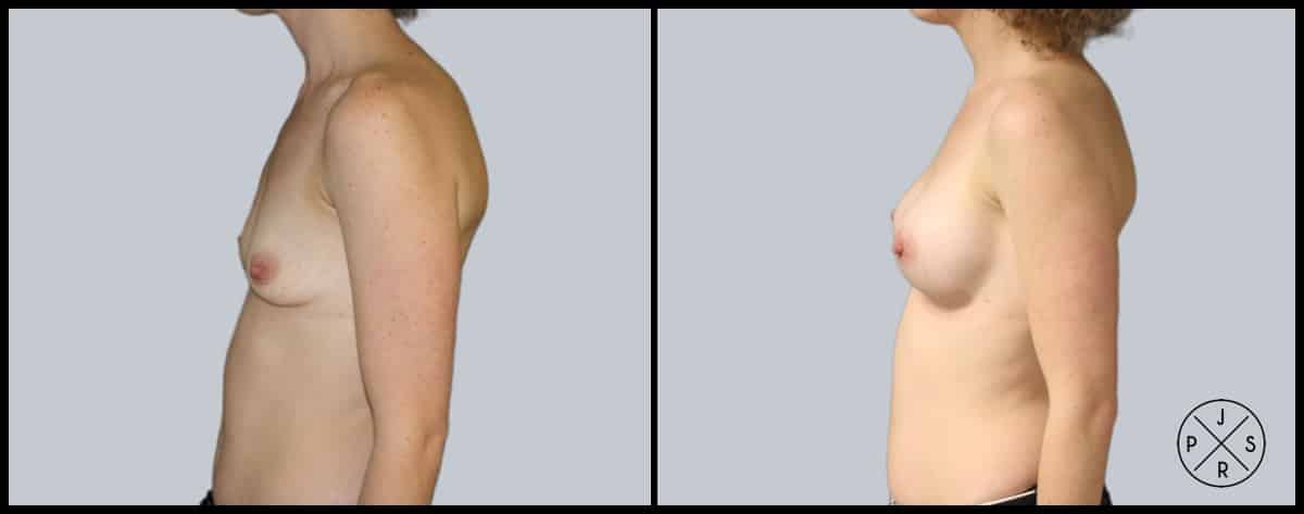 Breast Augmentation Before & After Image