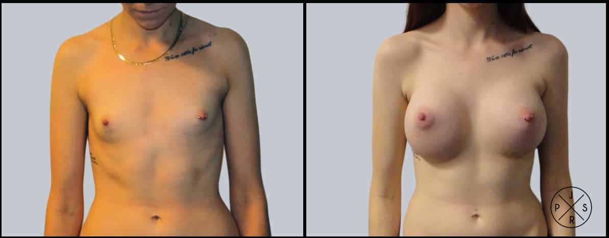 Breast Augmentation Before & After Image