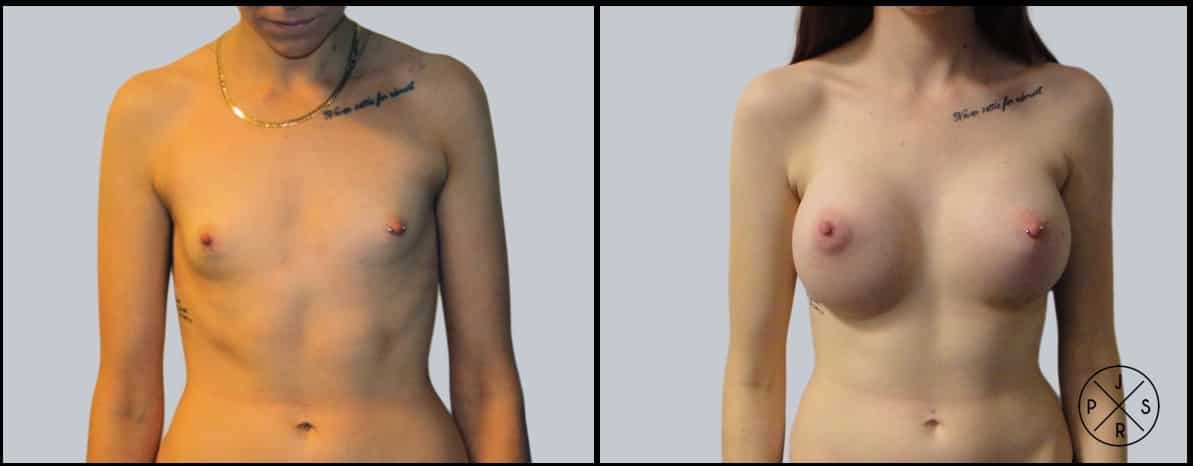 Breast Augmentation Before & After Image