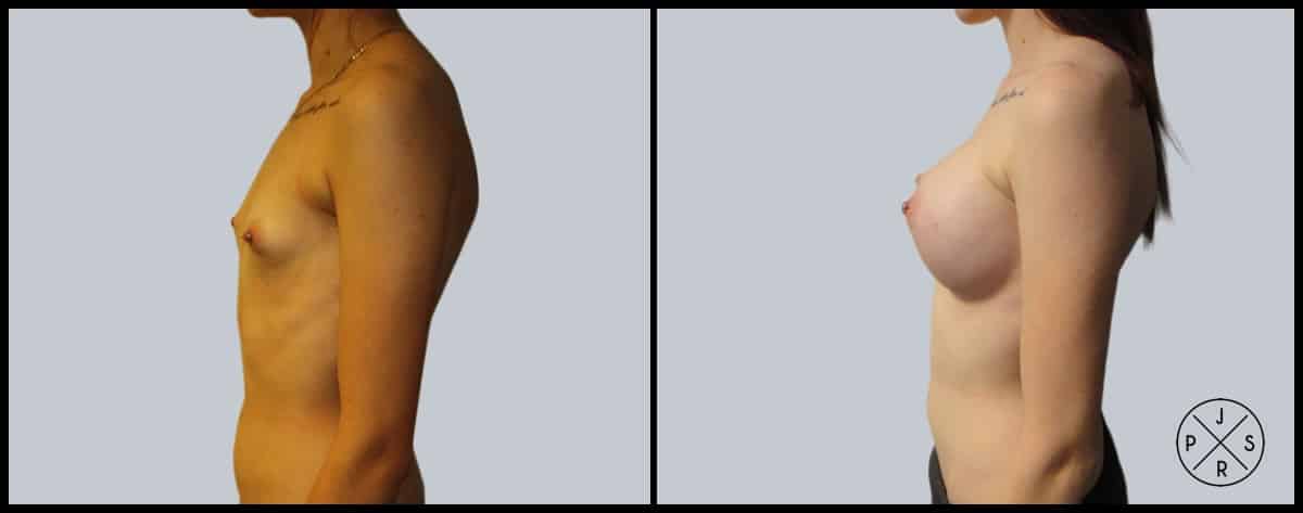 Breast Augmentation Before & After Image