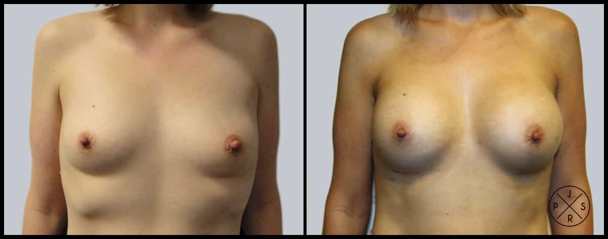 Breast Augmentation Before & After Image