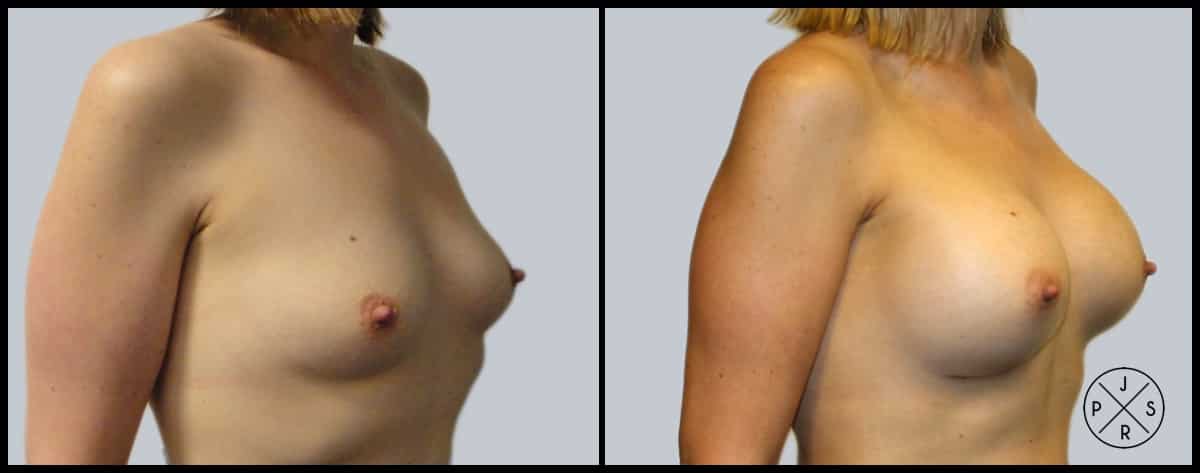 Breast Augmentation Before & After Image