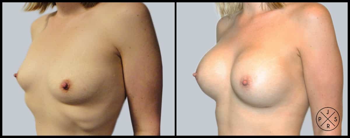 Breast Augmentation Before & After Image