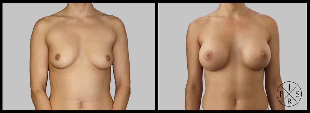 Breast Augmentation Before & After Image