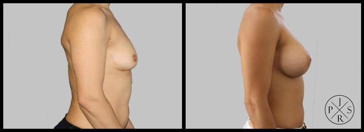 Breast Augmentation Before & After Image