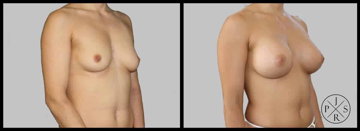 Breast Augmentation Before & After Image