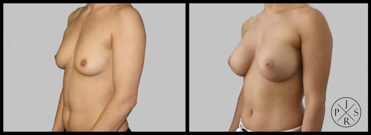 Breast Augmentation Before & After Image