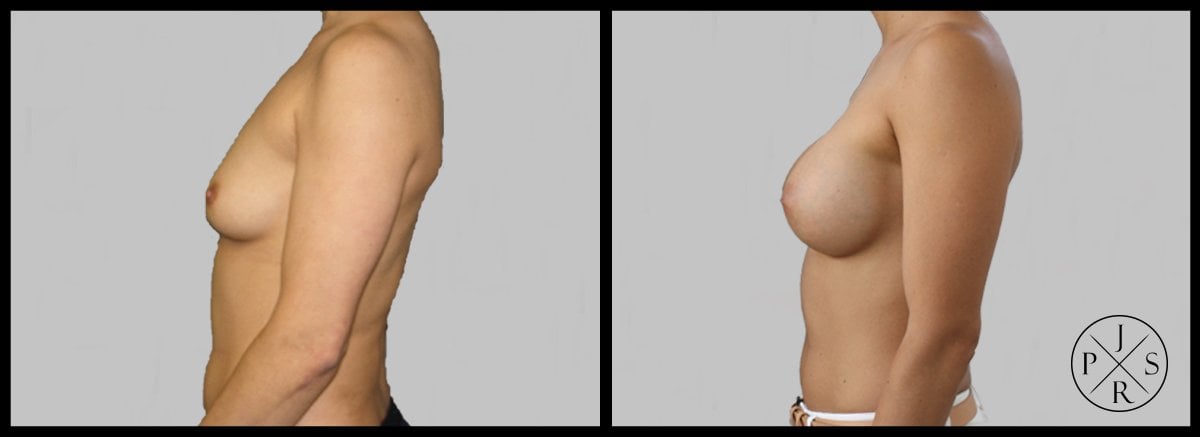 Breast Augmentation Before & After Image