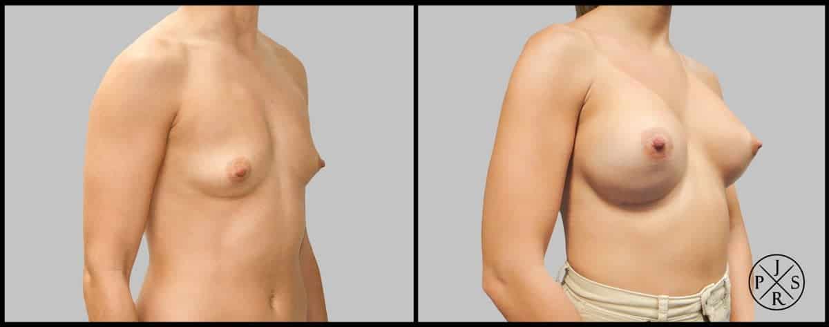 Breast Augmentation Before & After Image