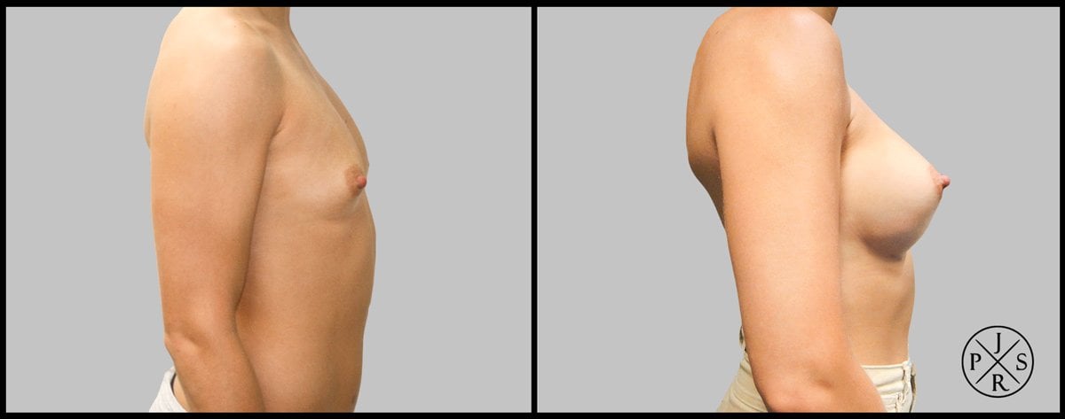 Breast Augmentation Before & After Image