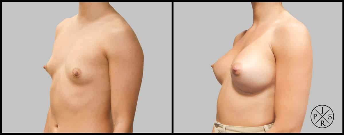 Breast Augmentation Before & After Image