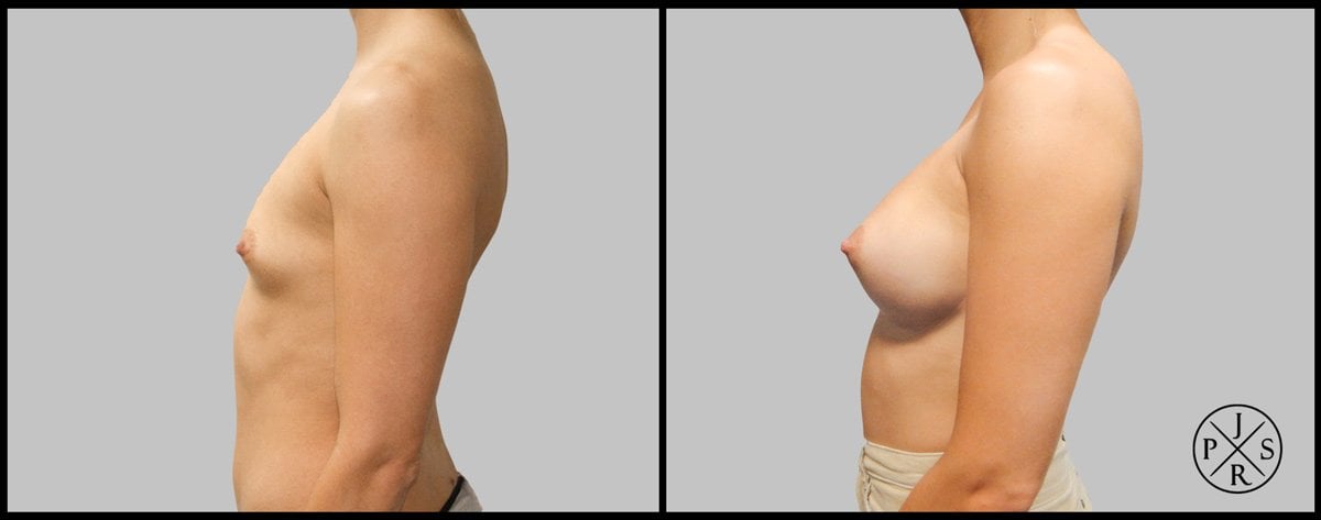 Breast Augmentation Before & After Image