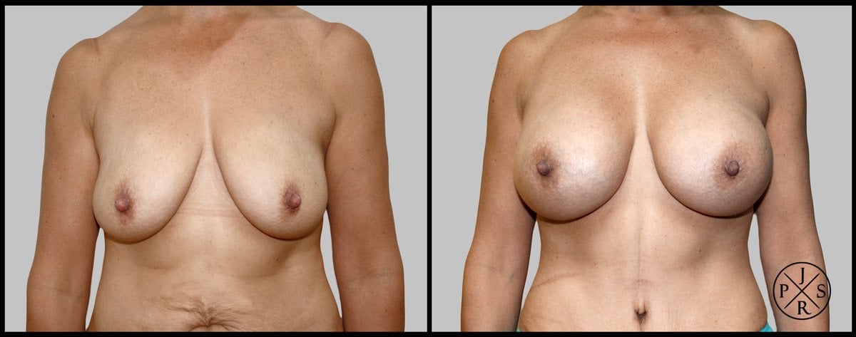 Breast Augmentation Before & After Image