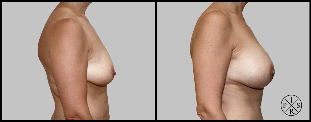 Breast Augmentation Before & After Image