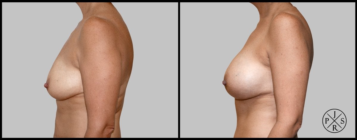 Breast Augmentation Before & After Image