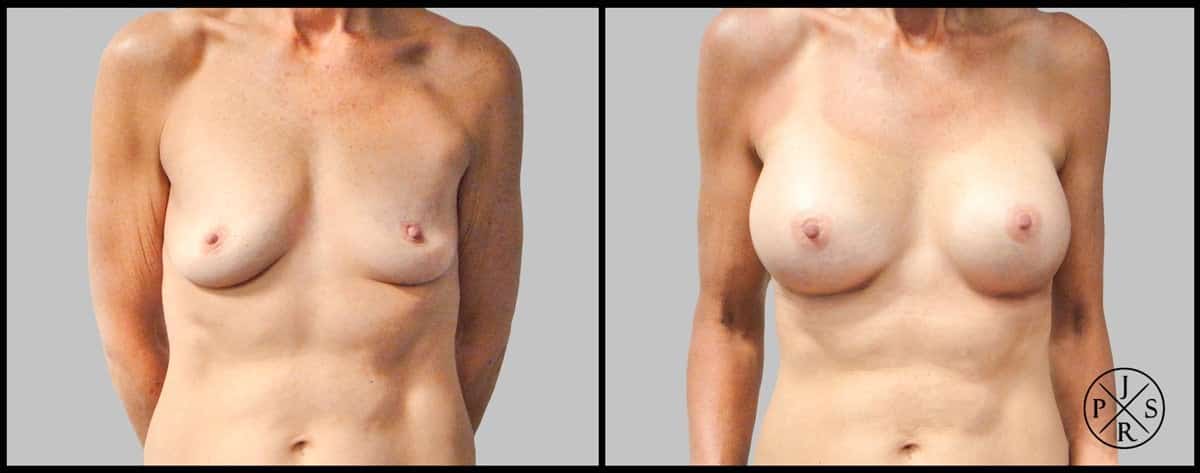 Breast Augmentation Before & After Image