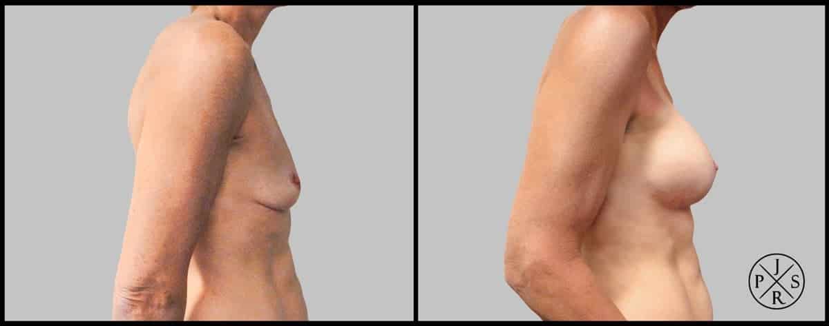 Breast Augmentation Before & After Image