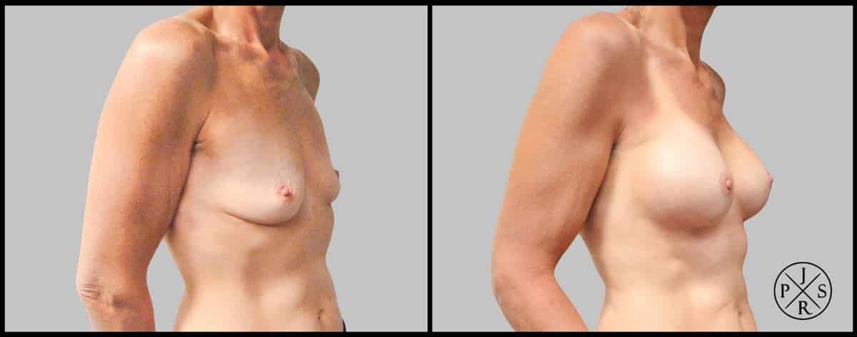 Breast Augmentation Before & After Image