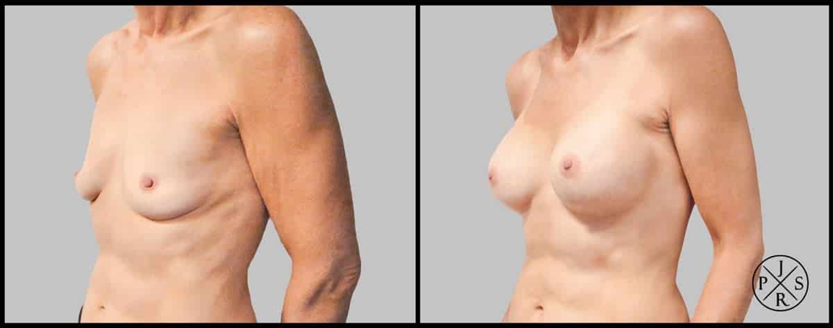 Breast Augmentation Before & After Image