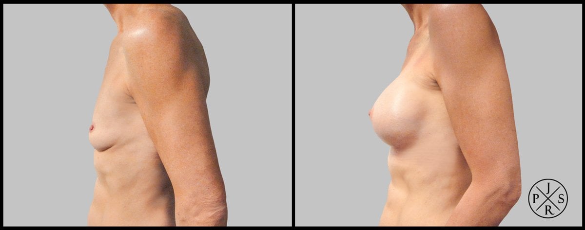 Breast Augmentation Before & After Image