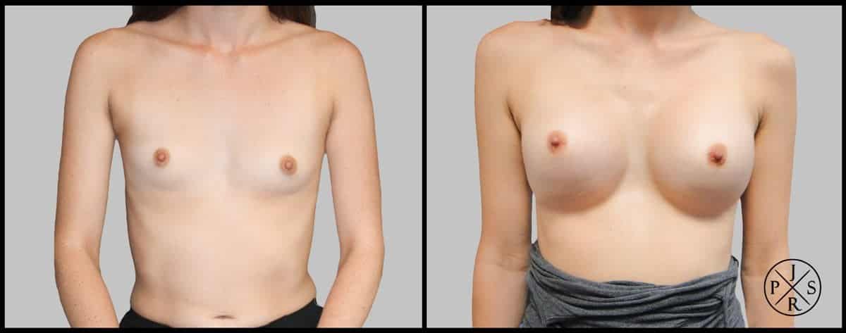 Breast Augmentation Before & After Image