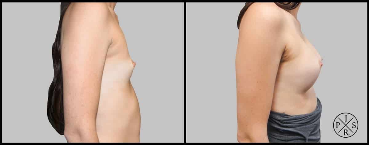 Breast Augmentation Before & After Image