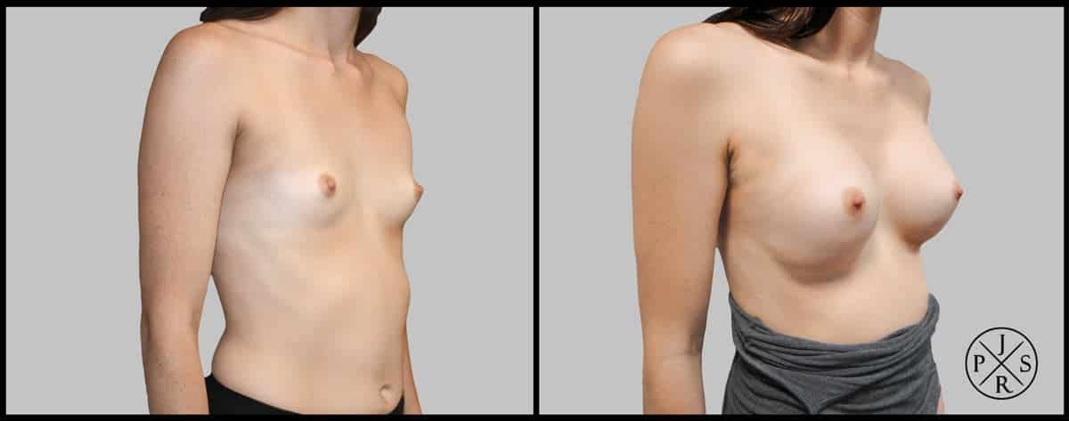 Breast Augmentation Before & After Image