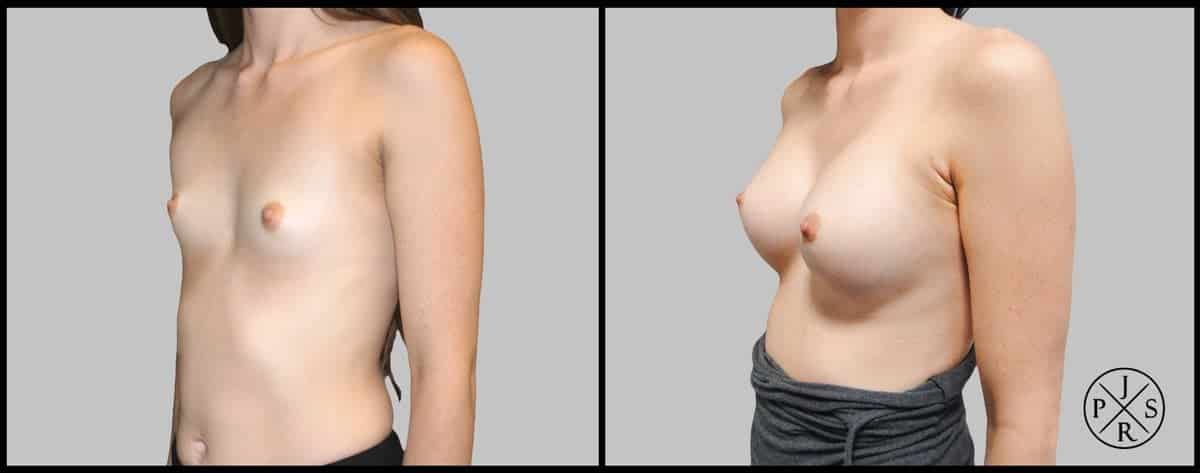 Breast Augmentation Before & After Image