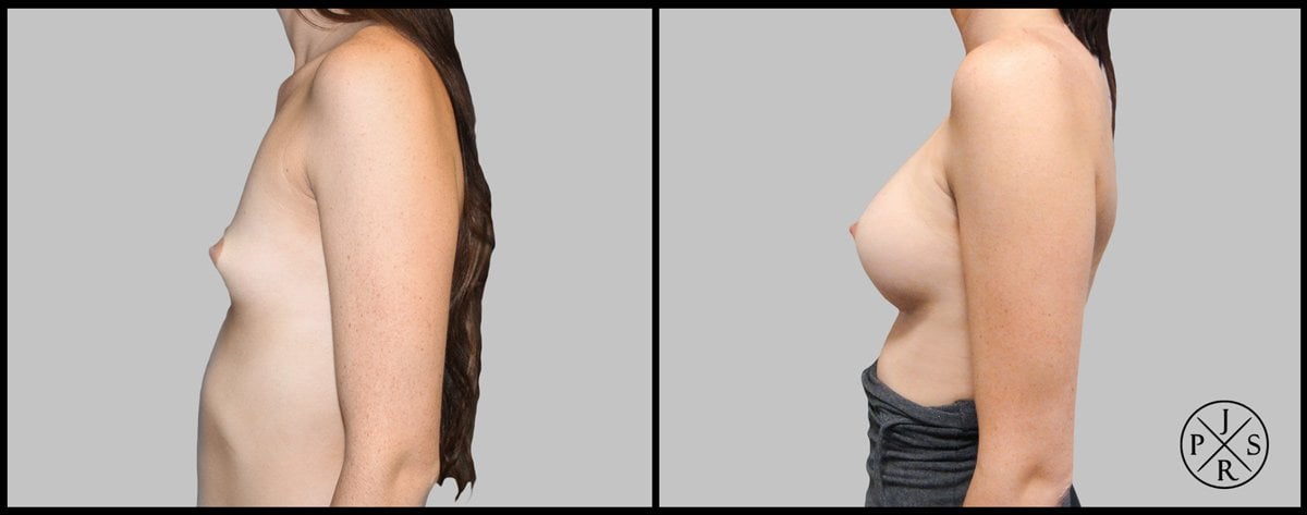 Breast Augmentation Before & After Image