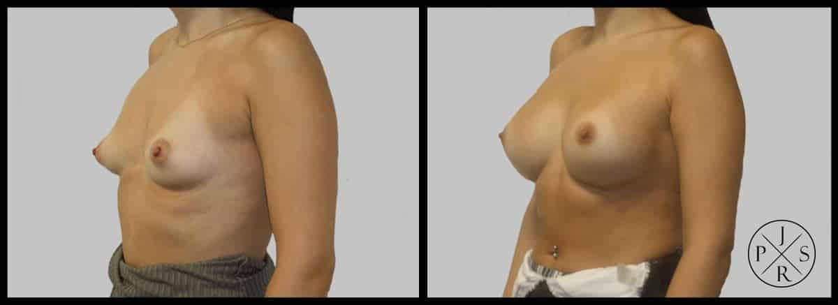 Breast Augmentation Before & After Image