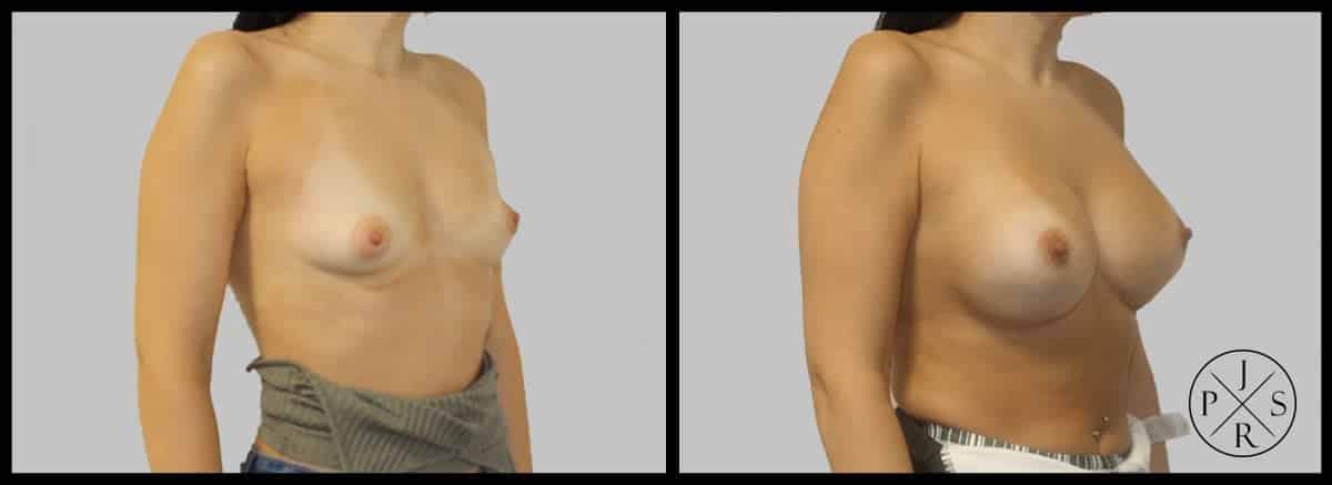 Breast Augmentation Before & After Image