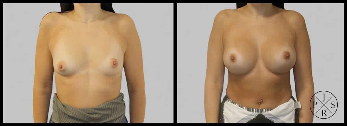 Breast Augmentation Before & After Image