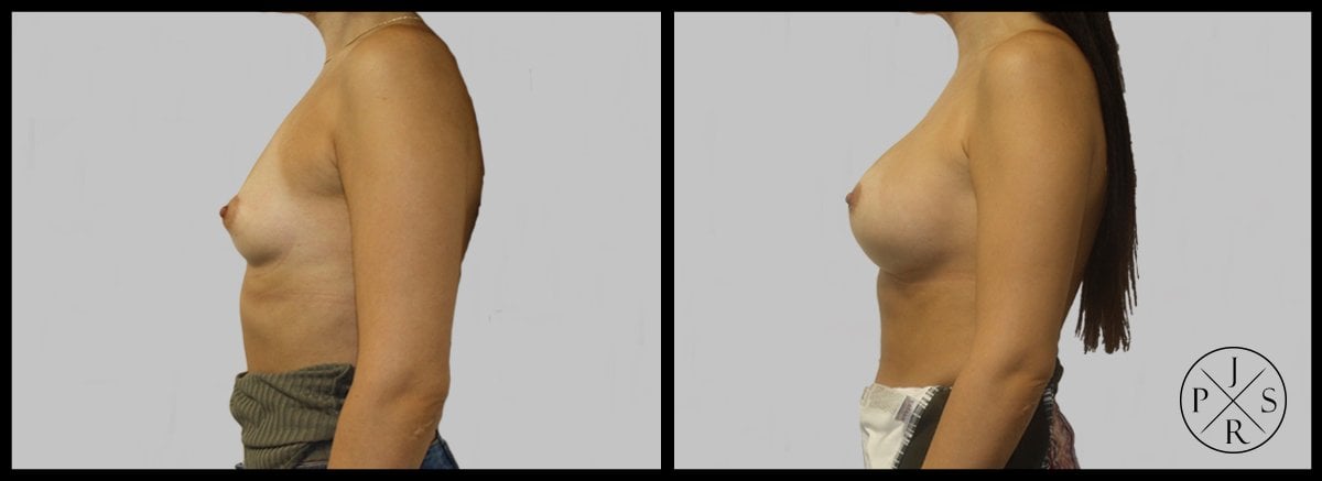 Breast Augmentation Before & After Image